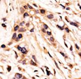 Formalin-fixed and paraffin-embedded human cancer tissue reacted with the primary antibody, which was peroxidase-conjugated to the secondary antibody, followed by AEC staining. This data demonstrates the use of this antibody for immunohistochemistry; clinical relevance has not been evaluated. BC = breast carcinoma; HC = hepatocarcinoma.