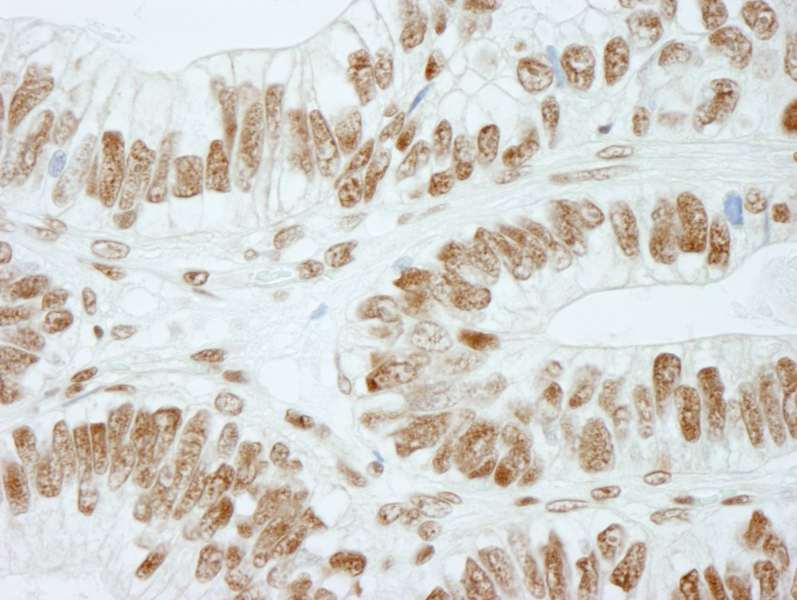 Detection of Human RbBP5 by Immunohistochemistry. Sample: FFPE section of human colon adenocarcinoma. Antibody: Affinity purified rabbit anti-RbBP5 used at a dilution of 1:250.