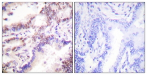 IHC of paraffin-embedded human lung carcinoma tissue, using CTIP (Ab-327) Antibody. The picture on the right is treated with the synthesized peptide.