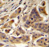 RBCK1 (UBCE7IP3) Antibody immunohistochemistry of formalin-fixed and paraffin-embedded human bladder carcinoma followed by peroxidase-conjugated secondary antibody and DAB staining.This data demonstrates the use of RBCK1 (UBCE7IP3) Antibody for immunohistochemistry.