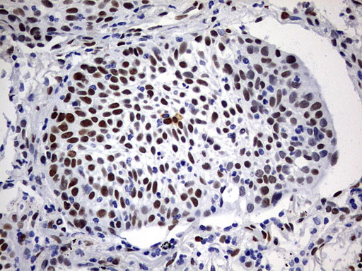 IHC of paraffin-embedded Carcinoma of Human lung tissue using anti-RBFOX1 mouse monoclonal antibody. (Heat-induced epitope retrieval by 1 mM EDTA in 10mM Tris, pH8.5, 120°C for 3min).