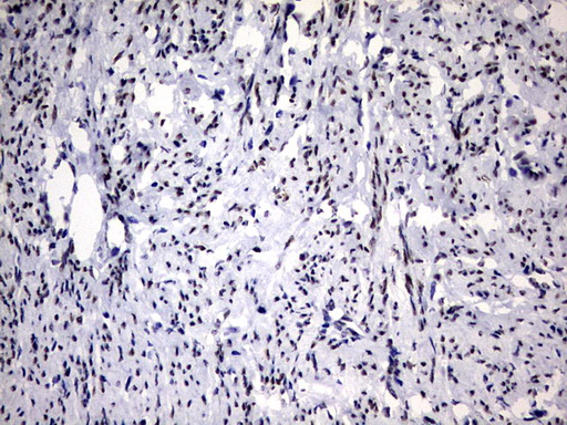 IHC of paraffin-embedded Adenocarcinoma of Human endometrium tissue using anti-RBFOX1 mouse monoclonal antibody. (Heat-induced epitope retrieval by 1 mM EDTA in 10mM Tris, pH8.5, 120°C for 3min).