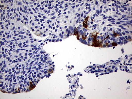 IHC of paraffin-embedded Carcinoma of Human lung tissue using anti-RBFOX1 mouse monoclonal antibody. (Heat-induced epitope retrieval by 1 mM EDTA in 10mM Tris, pH9.0, 120°C for 3min).