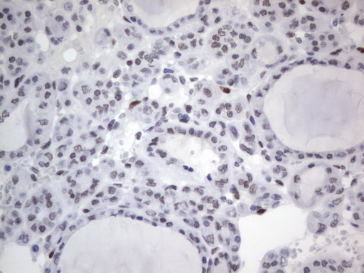 IHC of paraffin-embedded Carcinoma of Human thyroid tissue using anti-RBFOX1 mouse monoclonal antibody. (Heat-induced epitope retrieval by 1 mM EDTA in 10mM Tris, pH8.5, 120°C for 3min).