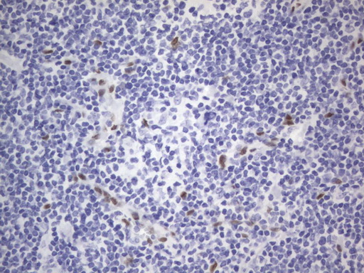 IHC of paraffin-embedded Human lymphoma tissue using anti-RBFOX1 mouse monoclonal antibody. (Heat-induced epitope retrieval by 1 mM EDTA in 10mM Tris, pH8.5, 120°C for 3min).