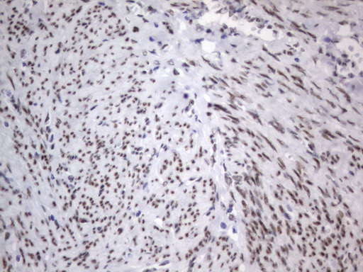 IHC of paraffin-embedded Adenocarcinoma of Human endometrium tissue using anti-RBFOX1 mouse monoclonal antibody. (Heat-induced epitope retrieval by 1 mM EDTA in 10mM Tris, pH8.5, 120°C for 3min).