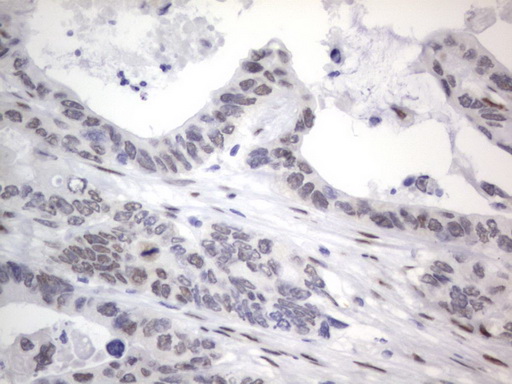 IHC of paraffin-embedded Adenocarcinoma of Human colon tissue using anti-RBFOX1 mouse monoclonal antibody. (Heat-induced epitope retrieval by 1 mM EDTA in 10mM Tris, pH8.5, 120°C for 3min).