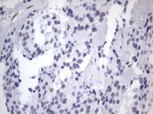 IHC of paraffin-embedded Adenocarcinoma of Human breast tissue using anti-RBFOX1 mouse monoclonal antibody. (Heat-induced epitope retrieval by 1 mM EDTA in 10mM Tris, pH8.5, 120°C for 3min).