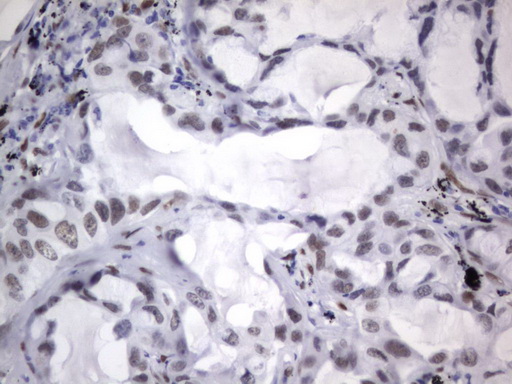 IHC of paraffin-embedded Carcinoma of Human lung tissue using anti-RBFOX1 mouse monoclonal antibody. (Heat-induced epitope retrieval by 1 mM EDTA in 10mM Tris, pH8.5, 120°C for 3min).