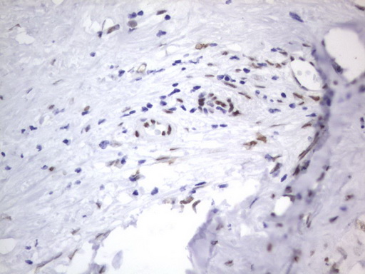 IHC of paraffin-embedded Carcinoma of Human liver tissue using anti-RBFOX1 mouse monoclonal antibody. (Heat-induced epitope retrieval by 1 mM EDTA in 10mM Tris, pH8.5, 120°C for 3min).