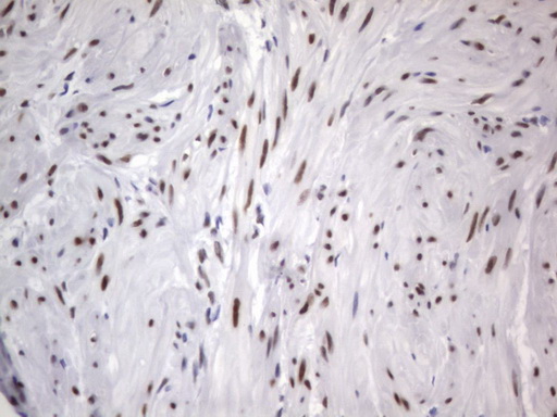 IHC of paraffin-embedded Carcinoma of Human kidney tissue using anti-RBFOX1 mouse monoclonal antibody. (Heat-induced epitope retrieval by 1 mM EDTA in 10mM Tris, pH8.5, 120°C for 3min).