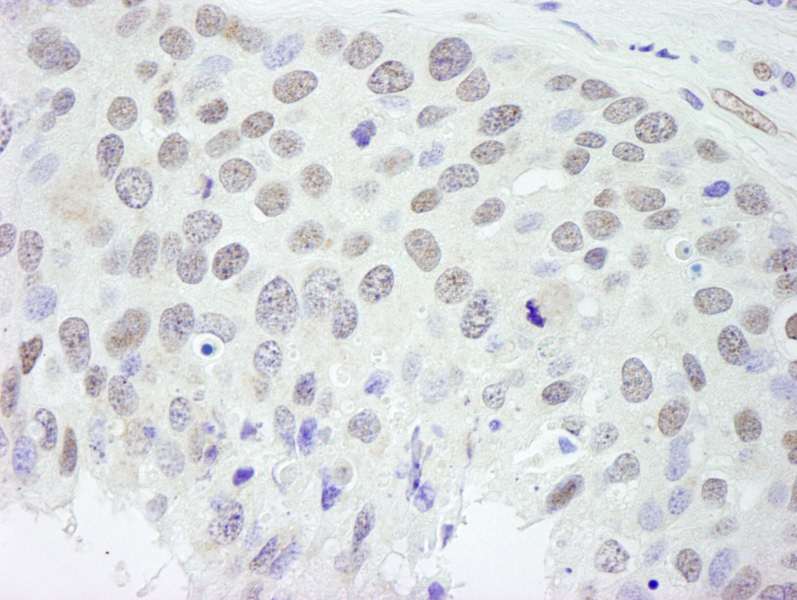 Detection of Human RBM9 by Immunohistochemistry. Sample: FFPE section of human breast carcinoma. Antibody: Affinity purified rabbit anti-RBM9 used at a dilution of 1:250.