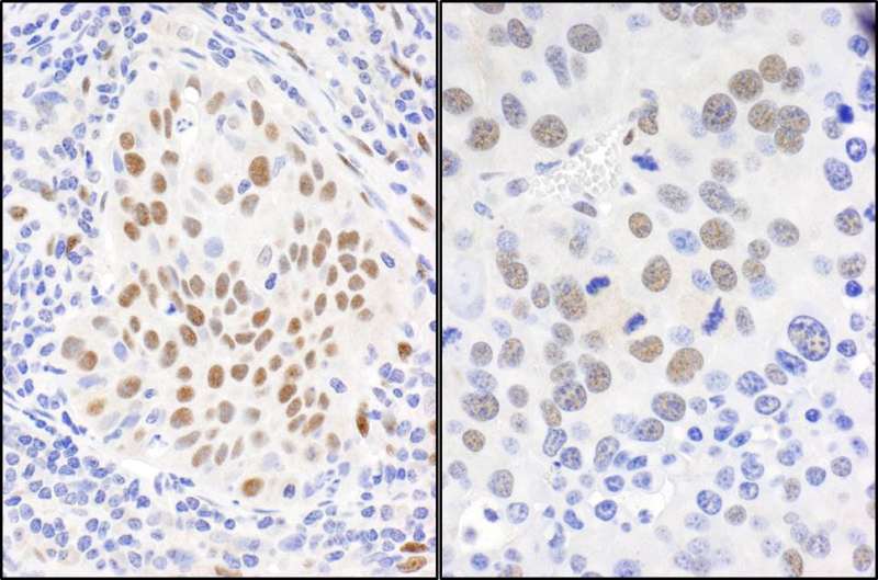 Detection of Human and Mouse Immunohistochemistry. Sample: FFPE sections of human lung carcinoma (left) and mouse renal cell carcinoma (right). Antibody: Affinity purified rabbit anti-No. Lot2) used at a dilution of 1:1000 (1 ug/ml). Detection: DAB.