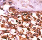 Formalin-fixed and paraffin-embedded human cancer tissue reacted with the primary antibody, which was peroxidase-conjugated to the secondary antibody, followed by AEC staining. This data demonstrates the use of this antibody for immunohistochemistry; clinical relevance has not been evaluated. BC = breast carcinoma; HC = hepatocarcinoma.