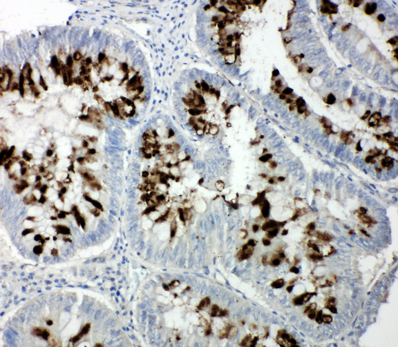 RBL1 / p107 antibody. IHC(P): Human Intestinal Cancer Tissue.