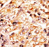 Formalin-fixed and paraffin-embedded human cancer tissue reacted with the primary antibody, which was peroxidase-conjugated to the secondary antibody, followed by AEC staining. This data demonstrates the use of this antibody for immunohistochemistry; clinical relevance has not been evaluated. BC = breast carcinoma; HC = hepatocarcinoma.