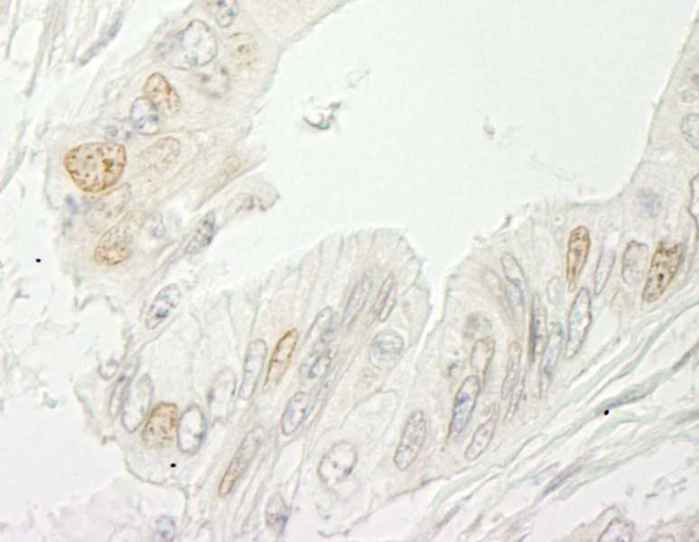 Detection of Human RBM10 by Immunohistochemistry. Sample: FFPE section of human colon carcinoma. Antibody: Affinity purified rabbit anti-RBM10 used at a dilution of 1:200.