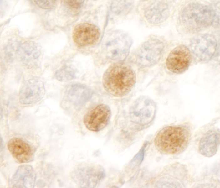 Detection of Human RBM10 by Immunohistochemistry. Sample: FFPE section of human testicular seminoma. Antibody: Affinity purified rabbit anti-RBM10 used at a dilution of 1:200 (1 ug/ml). Detection: DAB.