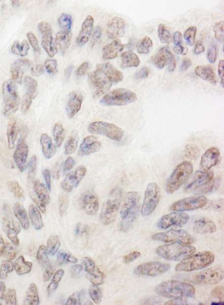Detection of Human RBM12 by Immunohistochemistry. Sample: FFPE section of human ovarian carcinoma. Antibody: Affinity purified rabbit anti-RBM12 used at a dilution of 1:200 (1 ug/ml). Detection: DAB.
