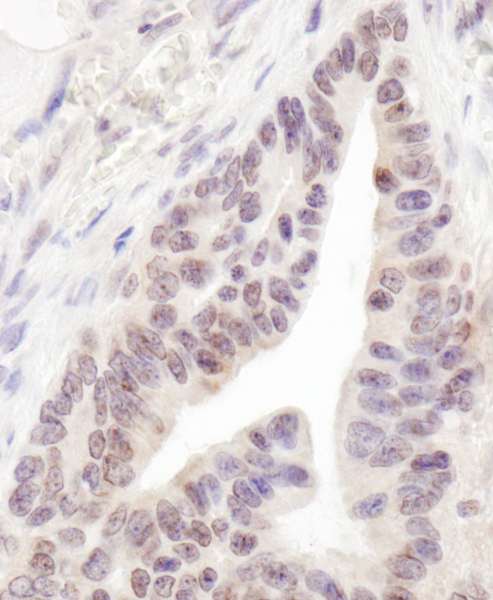 Detection of Human RBM12 by Immunohistochemistry. Sample: FFPE section of human ovarian carcinoma. Antibody: Affinity purified rabbit anti-RBM12 used at a dilution of 1:200 (1 ug/ml). Detection: DAB.