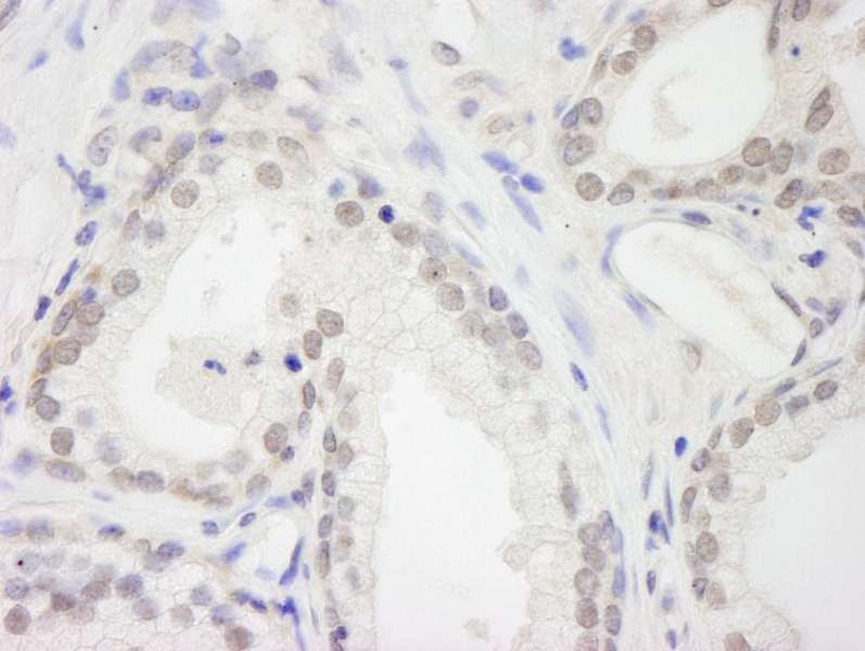 Detection of Human RBM12 by Immunohistochemistry. Sample: FFPE section of human prostate carcinoma. Antibody: Affinity purified rabbit anti-RBM12 used at a dilution of 1:250.