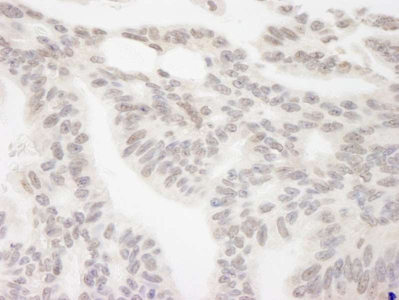 Detection of Human RBM12 by Immunohistochemistry. Sample: FFPE section of human ovarian carcinoma. Antibody: Affinity purified rabbit anti-RBM12 used at a dilution of 1:250.