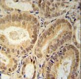 RBM24 Antibody immunohistochemistry of formalin-fixed and paraffin-embedded human prostate carcinoma followed by peroxidase-conjugated secondary antibody and DAB staining.
