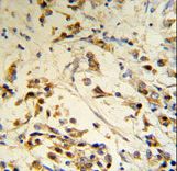 RBM3 Antibody (RB18776) IHC of formalin-fixed and paraffin-embedded human breast carcinoma followed by peroxidase-conjugated secondary antibody and DAB staining.