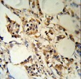RBM3 Antibody (RB18777) IHC of formalin-fixed and paraffin-embedded human breast carcinoma followed by peroxidase-conjugated secondary antibody and DAB staining.