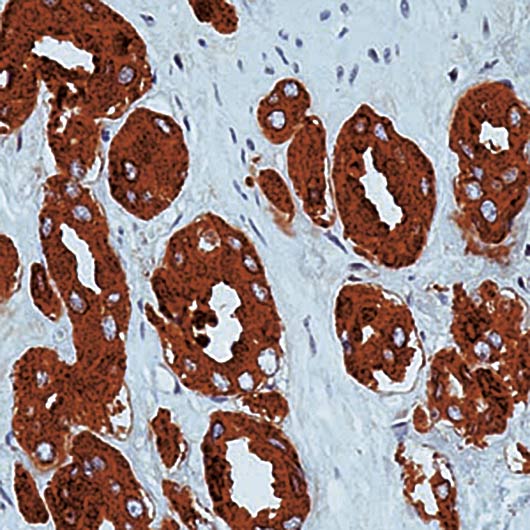 Formalin-fixed, paraffin-embedded human prostate stained with PSA antibody LS-C95878.