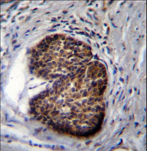PSCA Antibody immunohistochemistry of formalin-fixed and paraffin-embedded human prostate carcinoma followed by peroxidase-conjugated secondary antibody and DAB staining.