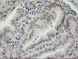 IHC of paraffin-embedded Adenocarcinoma of Human endometrium tissue using anti-RBPMS mouse monoclonal antibody.