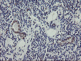 IHC of paraffin-embedded Carcinoma of Human kidney tissue using anti-RBPMS mouse monoclonal antibody.
