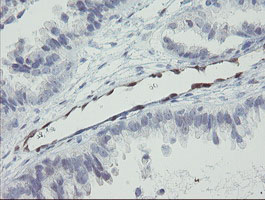 IHC of paraffin-embedded Adenocarcinoma of Human ovary tissue using anti-RBPMS mouse monoclonal antibody.