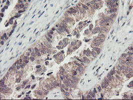 IHC of paraffin-embedded Adenocarcinoma of Human ovary tissue using anti-RBPMS mouse monoclonal antibody.