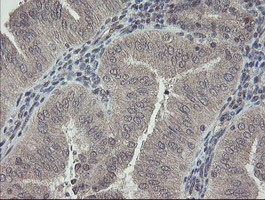 IHC of paraffin-embedded Adenocarcinoma of Human endometrium tissue using anti-RBPMS mouse monoclonal antibody.