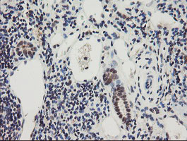 IHC of paraffin-embedded Carcinoma of Human kidney tissue using anti-RBPMS mouse monoclonal antibody.