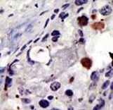 Formalin-fixed and paraffin-embedded human cancer tissue reacted with the primary antibody, which was peroxidase-conjugated to the secondary antibody, followed by AEC staining. This data demonstrates the use of this antibody for immunohistochemistry; clinical relevance has not been evaluated. BC = breast carcinoma; HC = hepatocarcinoma.