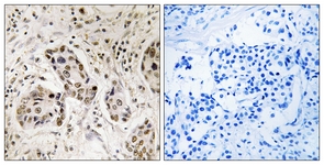 IHC of paraffin-embedded human breast carcinoma tissue, using RCC2 Antibody. The picture on the right is treated with the synthesized peptide.