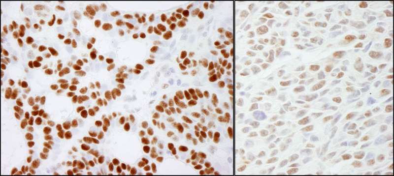 Detection of Human and Mouse RCC2 by Immunohistochemistry. Sample: FFPE sections of human skin basal cell carcinoma (left) and mouse CT26 colon carcinoma (right). Antibody: Affinity purified rabbit anti-RCC2 used at a dilution of 1:1000 (0.2 ug/ml) and 1:200 (1 ug/ml). Detection: DAB.