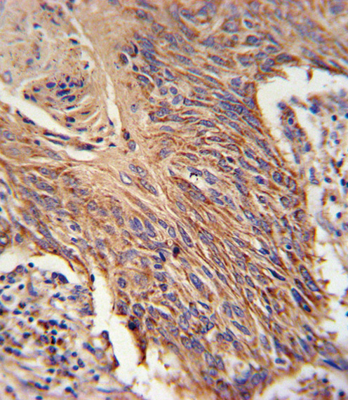RDH10 Antibody immunohistochemistry of formalin-fixed and paraffin-embedded lung carcinoma followed by peroxidase-conjugated secondary antibody and DAB staining.
