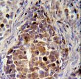 RDH16 Antibody (N-term immunohistochemistry of formalin-fixed and paraffin-embedded human skin carcinoma followed by peroxidase-conjugated secondary antibody and DAB staining.