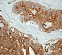 IHC of paraffin-embedded human ovarian carcinoma using anti-Radixin antibody.