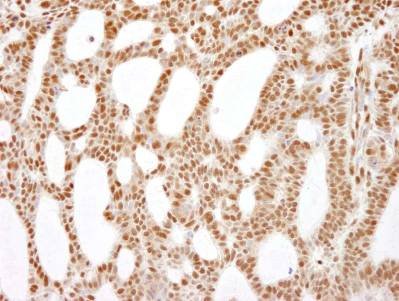 Detection of Human RecQ1 by Immunohistochemistry. Sample: FFPE section of human skin basal cell carcinoma. Antibody: Affinity purified rabbit anti-RecQ1 used at a dilution of 1:200 (1 ug/ml). Detection: DAB.