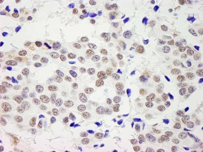 Detection of Human RecQ1 by Immunohistochemistry. Sample: FFPE section of human breast carcinoma. Antibody: Affinity purified rabbit anti-RecQ1 used at a dilution of 1:5000 (0.2 ug/ml). Detection: DAB.