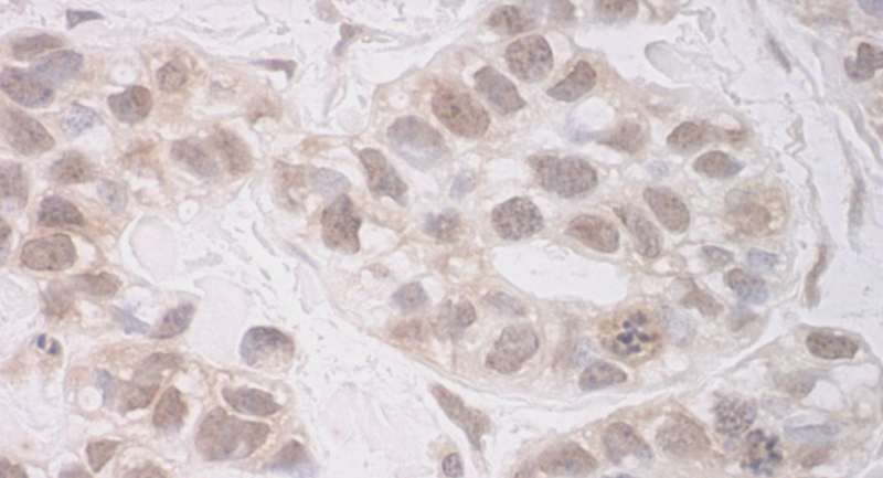Detection of Human RECQ5 by Immunohistochemistry. Sample: FFPE section of human breast carcinoma. Antibody: Affinity purified rabbit anti-RECQ5 used at a dilution of 1:1000 (1 ug/ml). Detection: DAB.