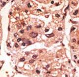Formalin-fixed and paraffin-embedded human cancer tissue reacted with the primary antibody, which was peroxidase-conjugated to the secondary antibody, followed by DAB staining. This data demonstrates the use of this antibody for immunohistochemistry; clinical relevance has not been evaluated. BC = breast carcinoma; HC = hepatocarcinoma.