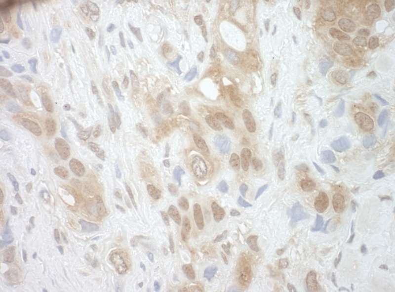 Detection of Human RECQ5 by Immunohistochemistry. Sample: FFPE section of human breast carcinoma. Antibody: Affinity purified rabbit anti-RECQ5 used at a dilution of 1:250.