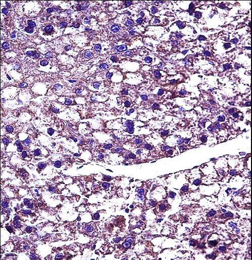 PROC Antibody immunohistochemistry of formalin-fixed and paraffin-embedded human hepatocarcinoma followed by peroxidase-conjugated secondary antibody and DAB staining.