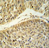 RERE Antibody IHC of formalin-fixed and paraffin-embedded lung carcinoma followed by peroxidase-conjugated secondary antibody and DAB staining.